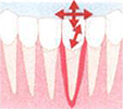 歯の動揺度検査